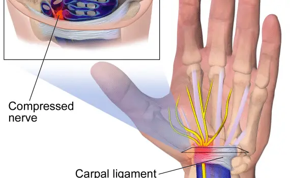 What Is Carpal Tunnel Syndrome - carpal tunnel is a compressed nerve in the carpal ligament