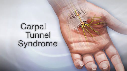 carpal tunnel syndrome relief