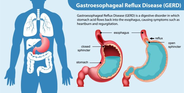 “Illustration of digestive system and reflux pressure caused by poor digestion”