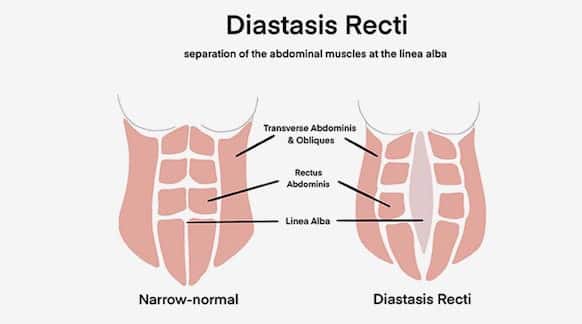 what is diastasis recti - is this condition responsible for bladder leakages?