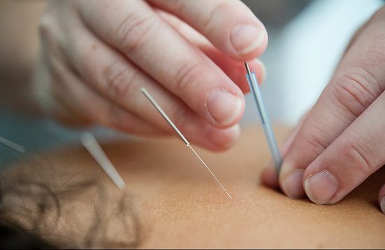 acupuncture, TCM for Health and Wellness
