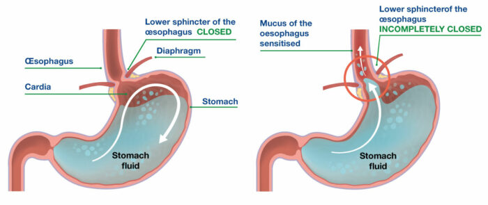 stomach acid digestion process diagram hydrochloric acid function